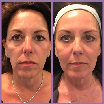 Masseur Tonique Micro-Courant - Lifting Facial Anti-Âge Professionnel